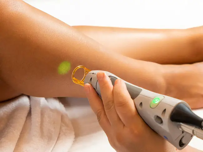 Eine Hand hält ein medizinisches Lasergerät mit einem goldfarbenen Applikator, das auf die Haut eines ausgestreckten Beins gerichtet ist. Das Bein liegt auf einem weißen Handtuch. Auf dem Lasergerät leuchtet eine grüne Kontrollanzeige. Ein grüner Laserpunkt ist auf der Haut sichtbar. Die Szene zeigt eine Laserbehandlung in unserer Hautarztpraxis